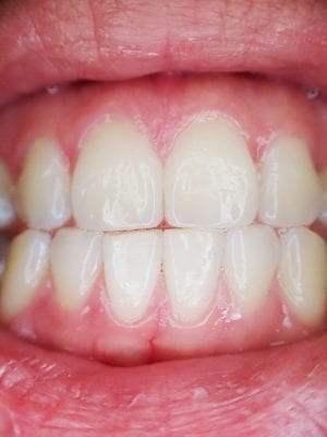 teeth-887338_960_720