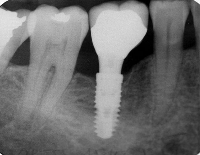 Molaire_sur_implant